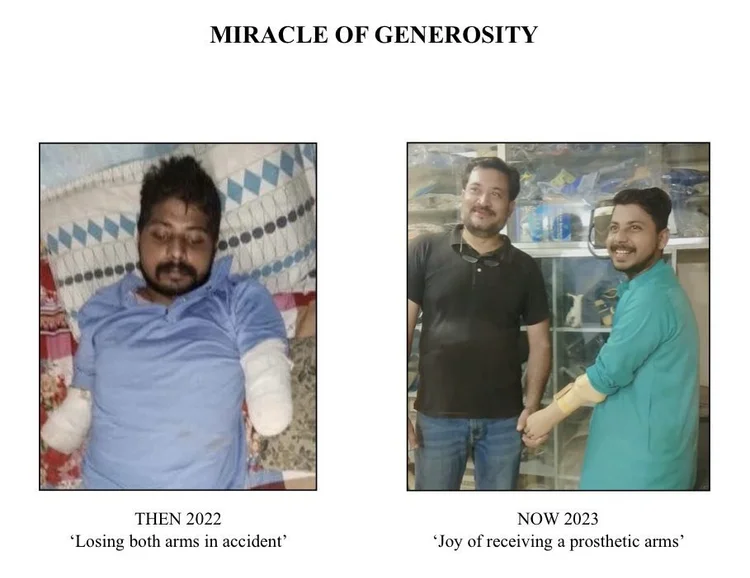 Sunil antes y después de recibir prótesis para los brazos.
